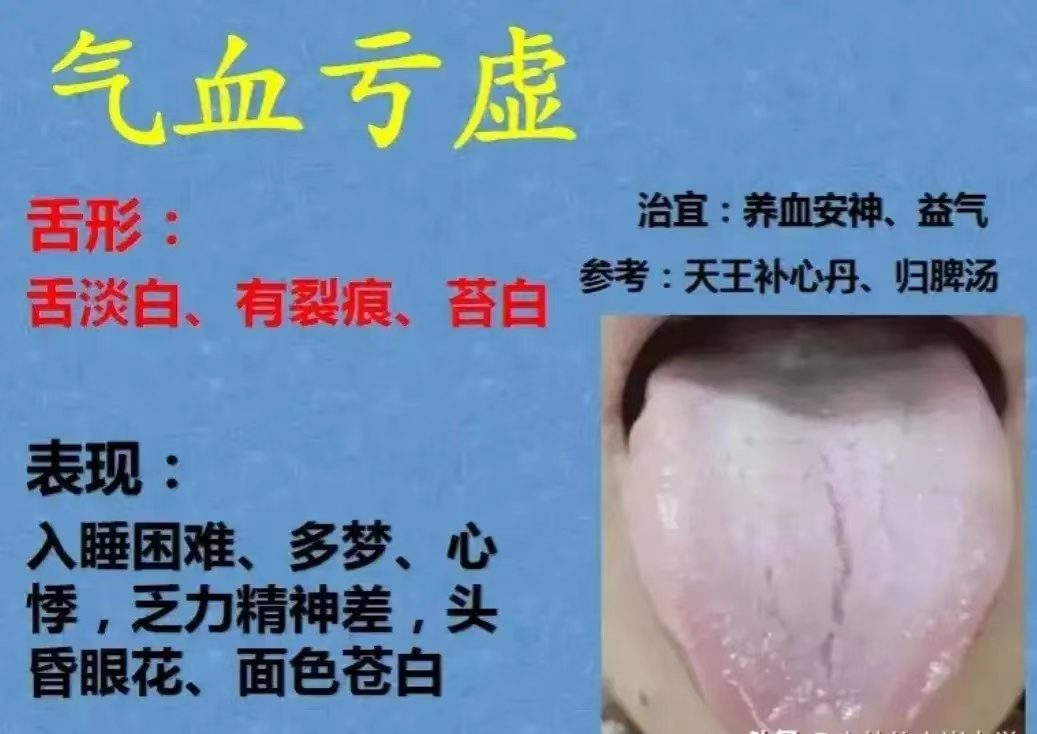 舌诊