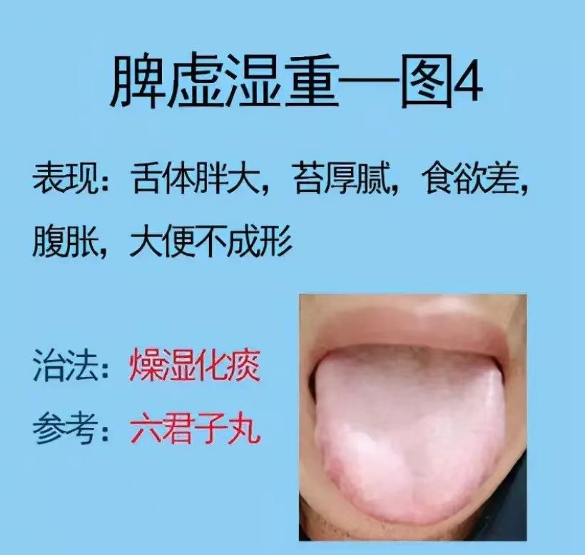 舌诊